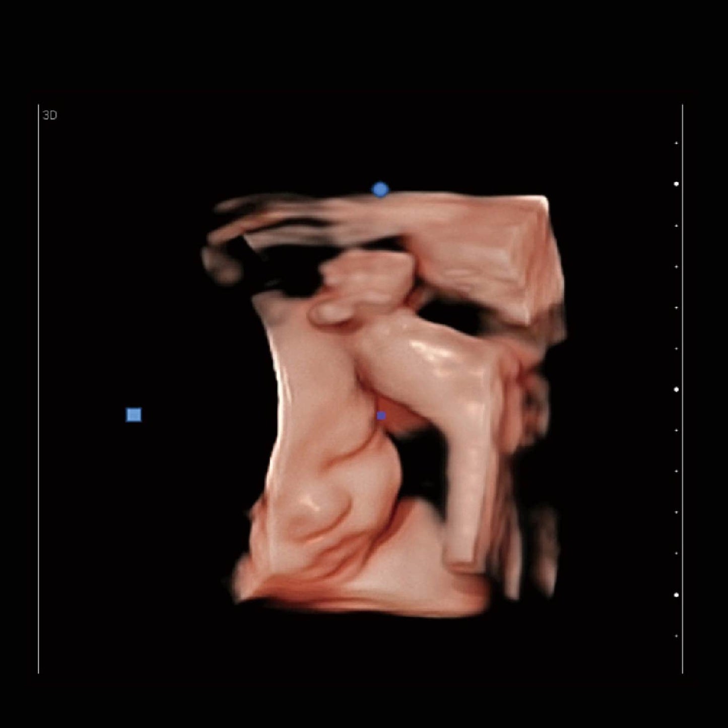 Chison - Échographe Portable Multifonction pour une Imagerie Médicale de Haute Précision EBit 30