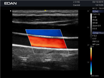 EDAN - Échographe Portable Acclarix AX3 – Système Ultrasons Compact Haute Performance