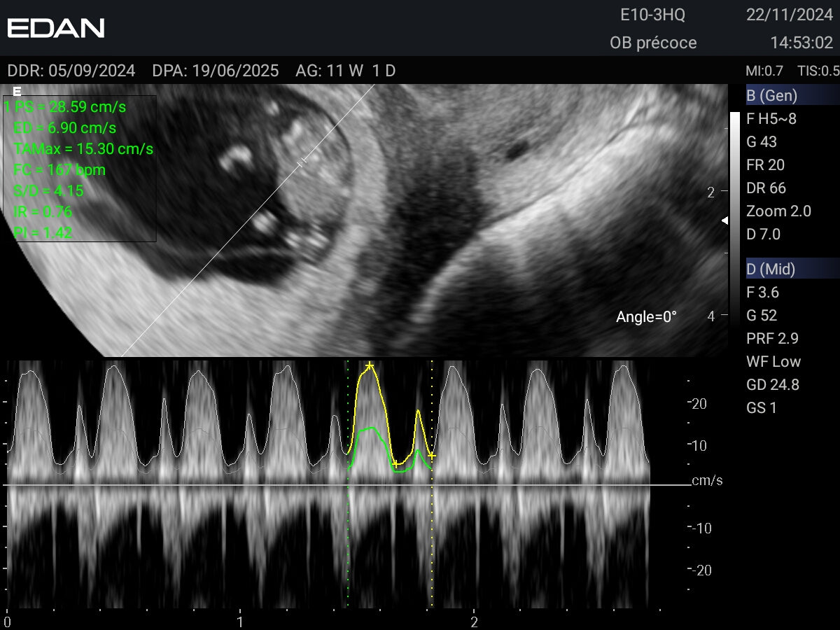 EDAN - Échographe Portable Acclarix AX3 – Système Ultrasons Compact Haute Performance