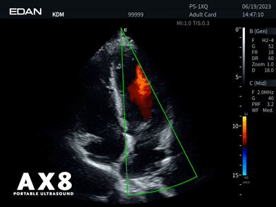EDAN - Échographe Portable Acclarix AX8 – Système Ultrasons Compact Haute Performance