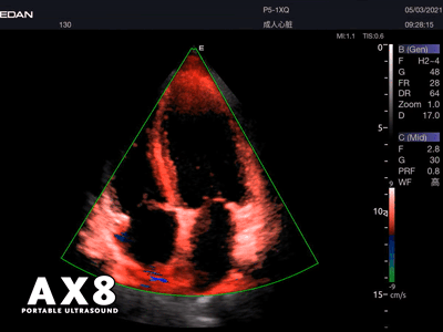 EDAN - Échographe Portable Acclarix AX8 – Système Ultrasons Compact Haute Performance