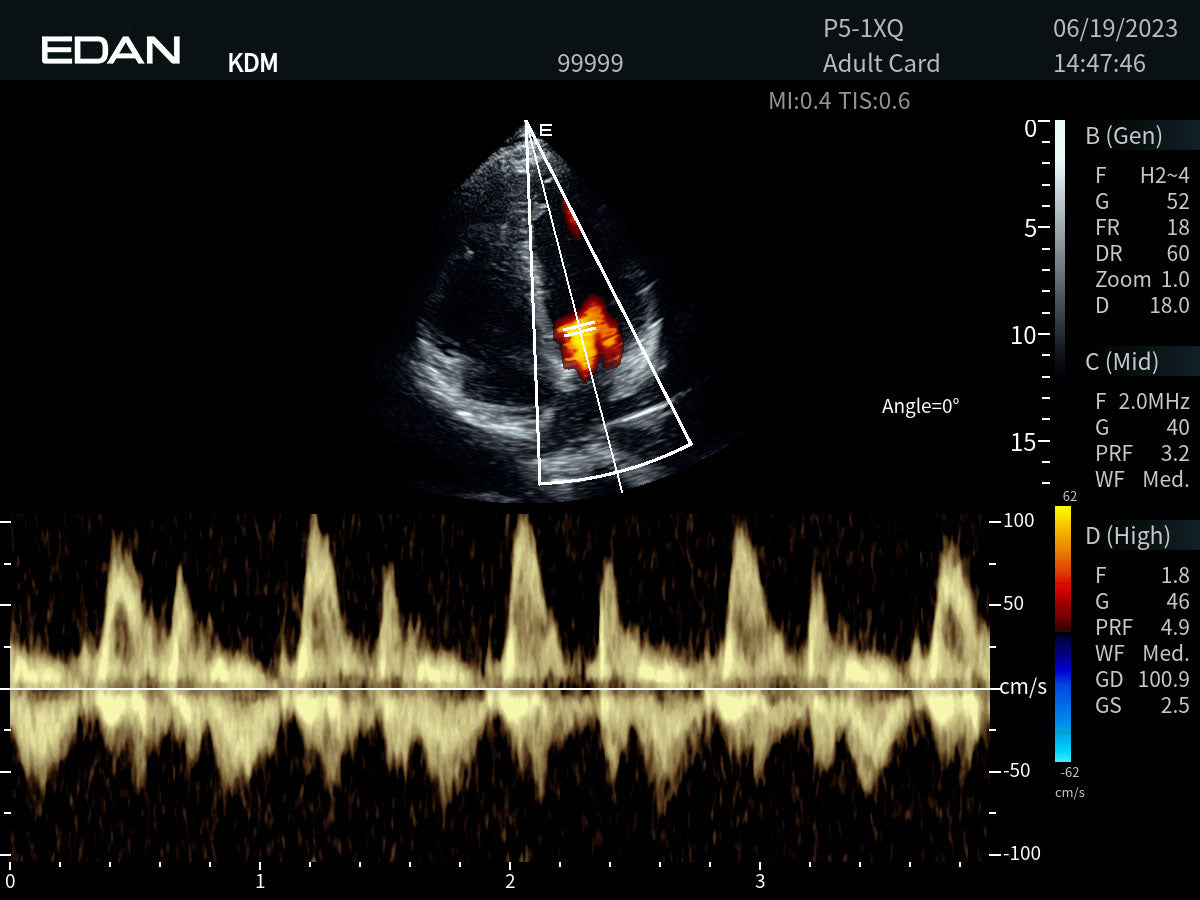 EDAN - Échographe Portable Acclarix AX8 – Système Ultrasons Compact Haute Performance